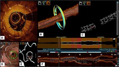A randomized control trial to assess optical coherence tomography parameters of the Xlimus drug-eluting stent: the XLIMIT trial